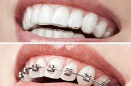 Invisible Aligners vs Braces: Complete Guide to Choosing the Right Orthodontic Treatment