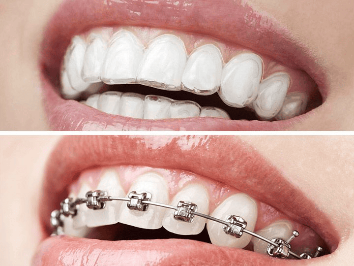 Invisible Aligners in Kochi