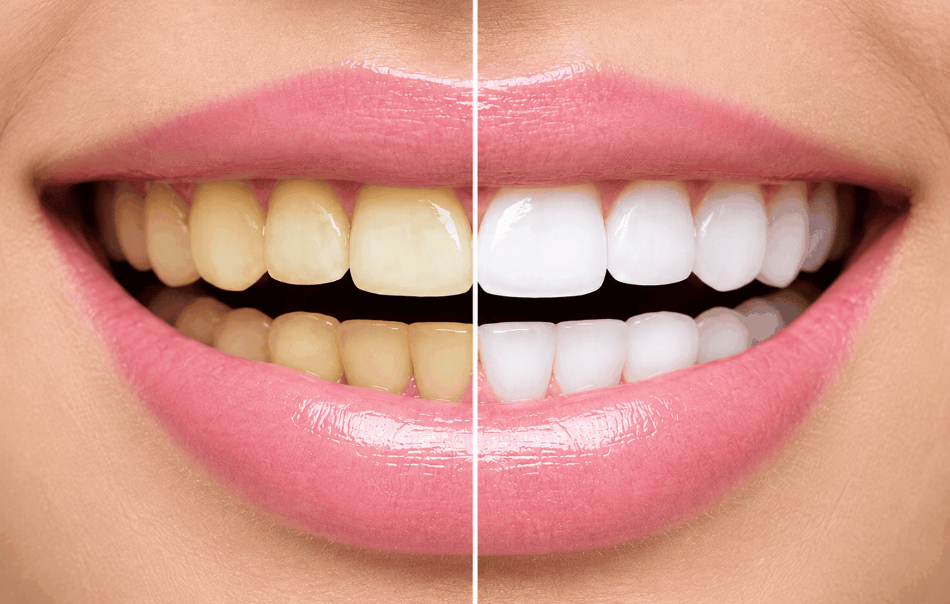 Teeth Whitening in Kochi