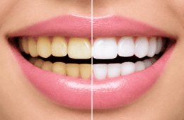 Teeth Whitening in Kochi: Complete Guide to Professional Teeth Whitening Treatments